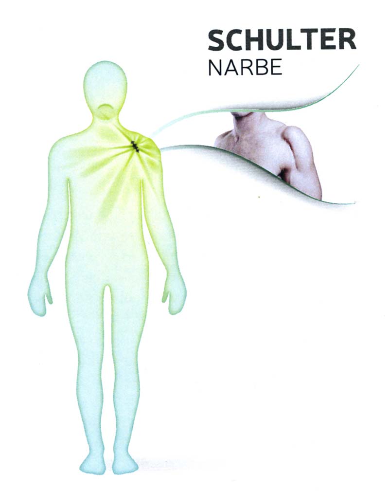 Welche Schmerzen können Narben verursachen? 3