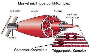 Triggerpunkte 2